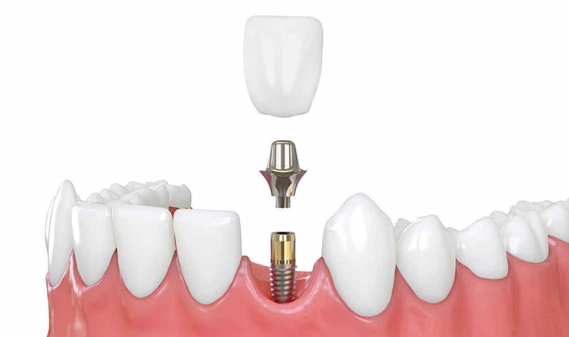 Can Dental Implants beAdvantageous or Disadvantageous? FCT