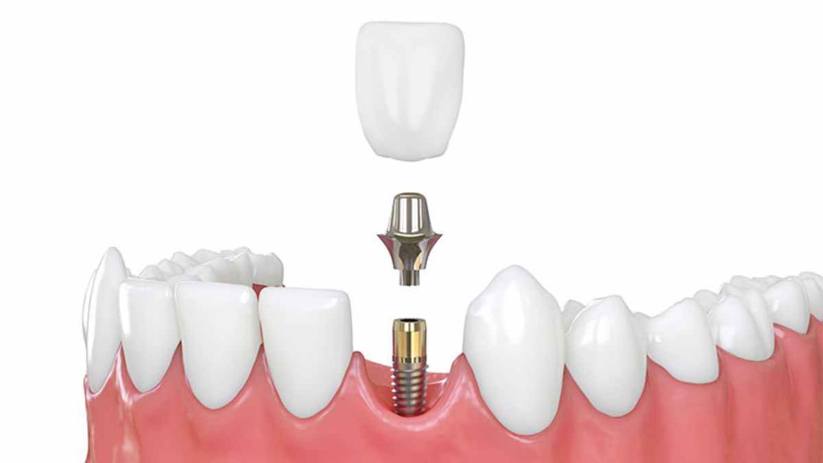 Can dental implants be advantageous or disadvantageous?