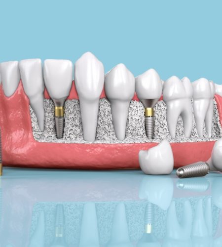 A Guide to the Types of Dental Implants in Turkey