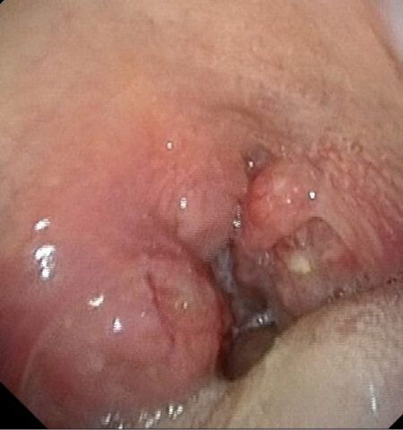 Sore Throat: 5 Tips to Feel Better
